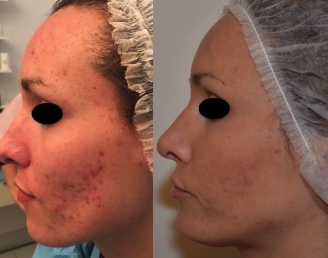 peeling chimico acne