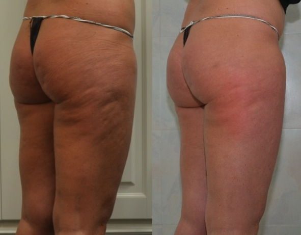 trattamenti per la cellulite