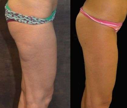 trattamenti per la cellulite