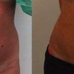 Liposcultura Monza &#8211; Risultati