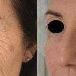 Ultherapy &#8211; Lifting volto e contorno occhi