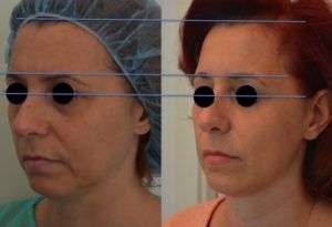 Ultherapy - Live da Milano