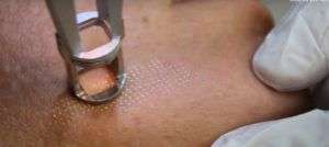 Cicatrici da acne con laser CO2 Frazionato