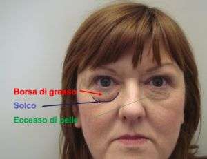 Blefaroplastica non chirurgica – un falso mito