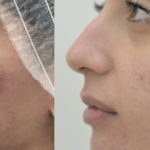 Acne &#8211; cura con peeling e laser