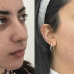 Acne &#8211; cura con peeling e laser