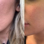 Acne &#8211; cura con peeling e laser
