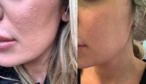 Acne - cura con peeling e laser