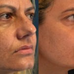 Acne &#8211; cura con peeling e laser