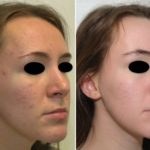 Acne &#8211; cura con peeling e laser