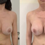 Sostituzione protesi mammaria per rotazione