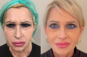 Ringiovanimento del volto – tecniche combinate di chirurgia plastica estetica.
