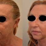 Associazione Endolift e ultrasuoni micro-focalizzati
