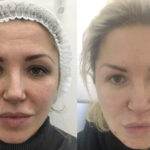 Filler acido Ialuronico per solchi nasali