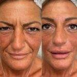 Filler acido Ialuronico per solchi nasali
