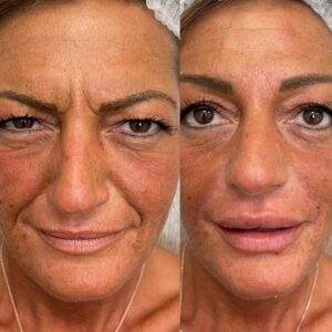 Filler acido Ialuronico per solchi nasali 