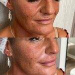 Filler acido Ialuronico per solchi nasali