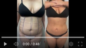 Liposuzione ultrasonica - Pre e post - Video