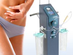 AcquaLipo – La liposcultura gentile approvata dalla scienza