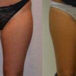 AcquaLipo – La liposcultura gentile approvata dalla scienza