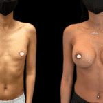 Mastoplastica Additiva senza dolore con tecnica Endoscopica in anestesia locale