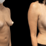 Mastoplastica Additiva senza dolore con tecnica Endoscopica in anestesia locale