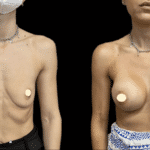 Mastoplastica Additiva senza dolore con tecnica Endoscopica in anestesia locale
