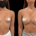 Mastoplastica Additiva senza dolore con tecnica Endoscopica in anestesia locale