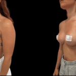 Mastoplastica Additiva senza dolore con tecnica Endoscopica in anestesia locale