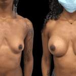 Mastoplastica Additiva senza dolore con tecnica Endoscopica in anestesia locale