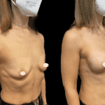 Mastoplastica Additiva senza dolore con tecnica Endoscopica in anestesia locale