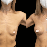 Mastoplastica Additiva senza dolore con tecnica Endoscopica in anestesia locale