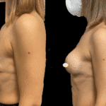 Mastoplastica Additiva senza dolore con tecnica Endoscopica in anestesia locale