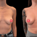 Mastoplastica Additiva senza dolore con tecnica Endoscopica in anestesia locale