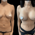Mastoplastica Additiva senza dolore con tecnica Endoscopica in anestesia locale