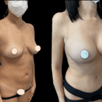 Mastoplastica Additiva senza dolore con tecnica Endoscopica in anestesia locale