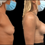 Mastoplastica Additiva senza dolore con tecnica Endoscopica in anestesia locale