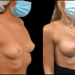 Mastoplastica Additiva senza dolore con tecnica Endoscopica in anestesia locale