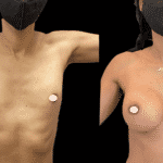 Mastoplastica Additiva senza dolore con tecnica Endoscopica in anestesia locale