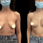 Mastoplastica Additiva senza dolore con tecnica Endoscopica in anestesia locale