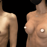 Mastoplastica Additiva senza dolore con tecnica Endoscopica in anestesia locale
