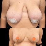 Mastoplastica Additiva senza dolore con tecnica Endoscopica in anestesia locale