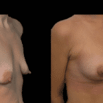Mastoplastica Additiva senza dolore con tecnica Endoscopica in anestesia locale