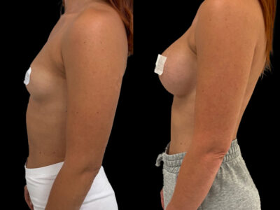 Mastoplastica di preservazione a Roma