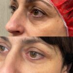 Trattamento delle occhiaie a Roma e Milano