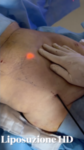 Liposuzione Vaser J plasma a Milano