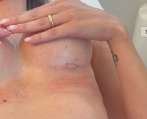 Paura della cicatrice nella Mastoplastica Additiva?
