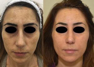Dermamelan: trattamento delle Macchie della pelle del volto