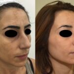 Dermamelan: trattamento delle Macchie della pelle del volto