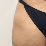 Filler Glutei – Complicanze